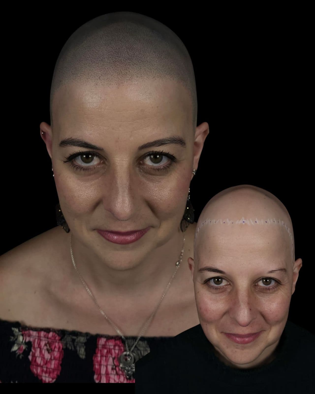 Alopecia en Mujeres